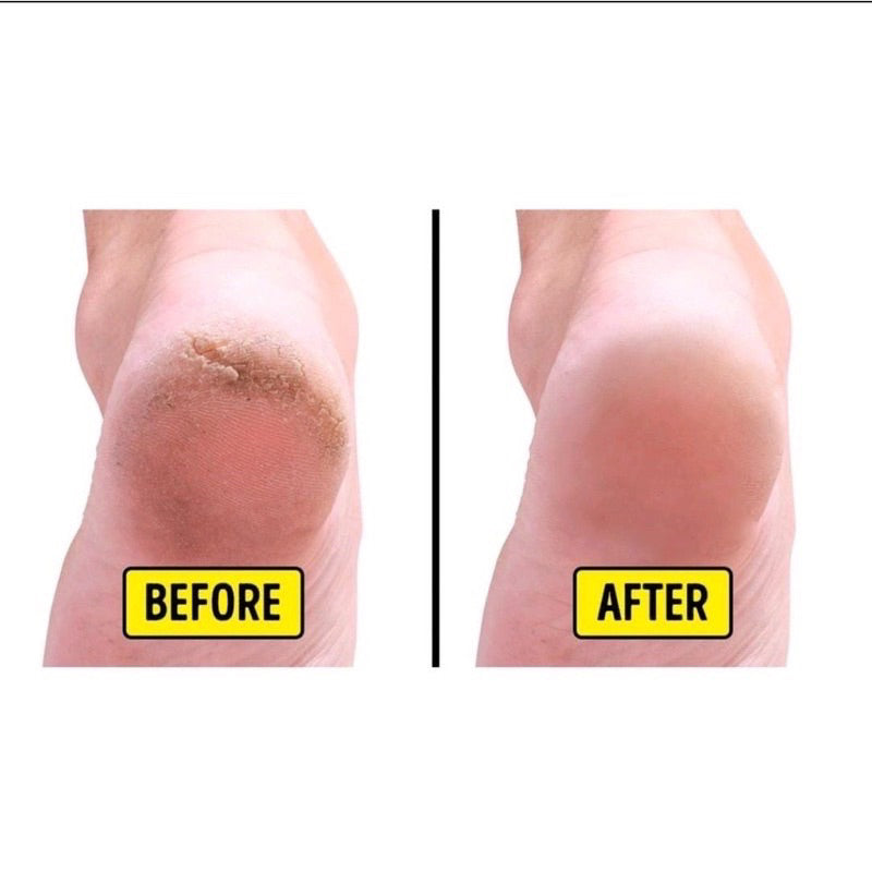 Par de Meia Palmilha Silicone Gel Protecao Ortopédica Esporão Calcanhar Fascite Tamanho Unico pronto entrega 😍Compre 1 Leve 2 😲
